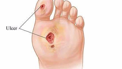 Which Diabetes Drug Best Protects Your Feet? New Study Finds a Slight Edge